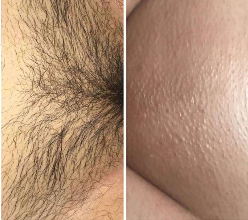Bikini and Brazilian wax before and after results at Full Circle Beauty San Diego